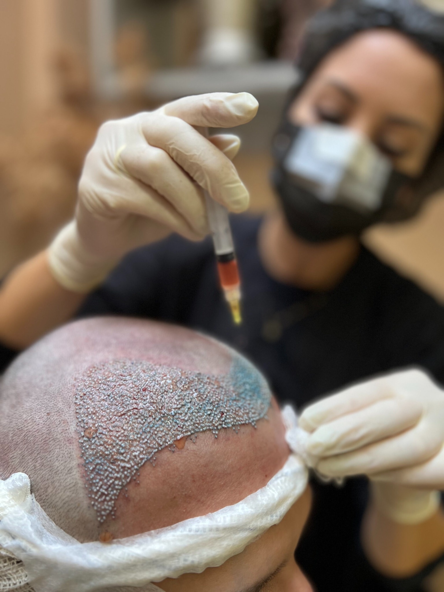 Transplante de folículos capilares