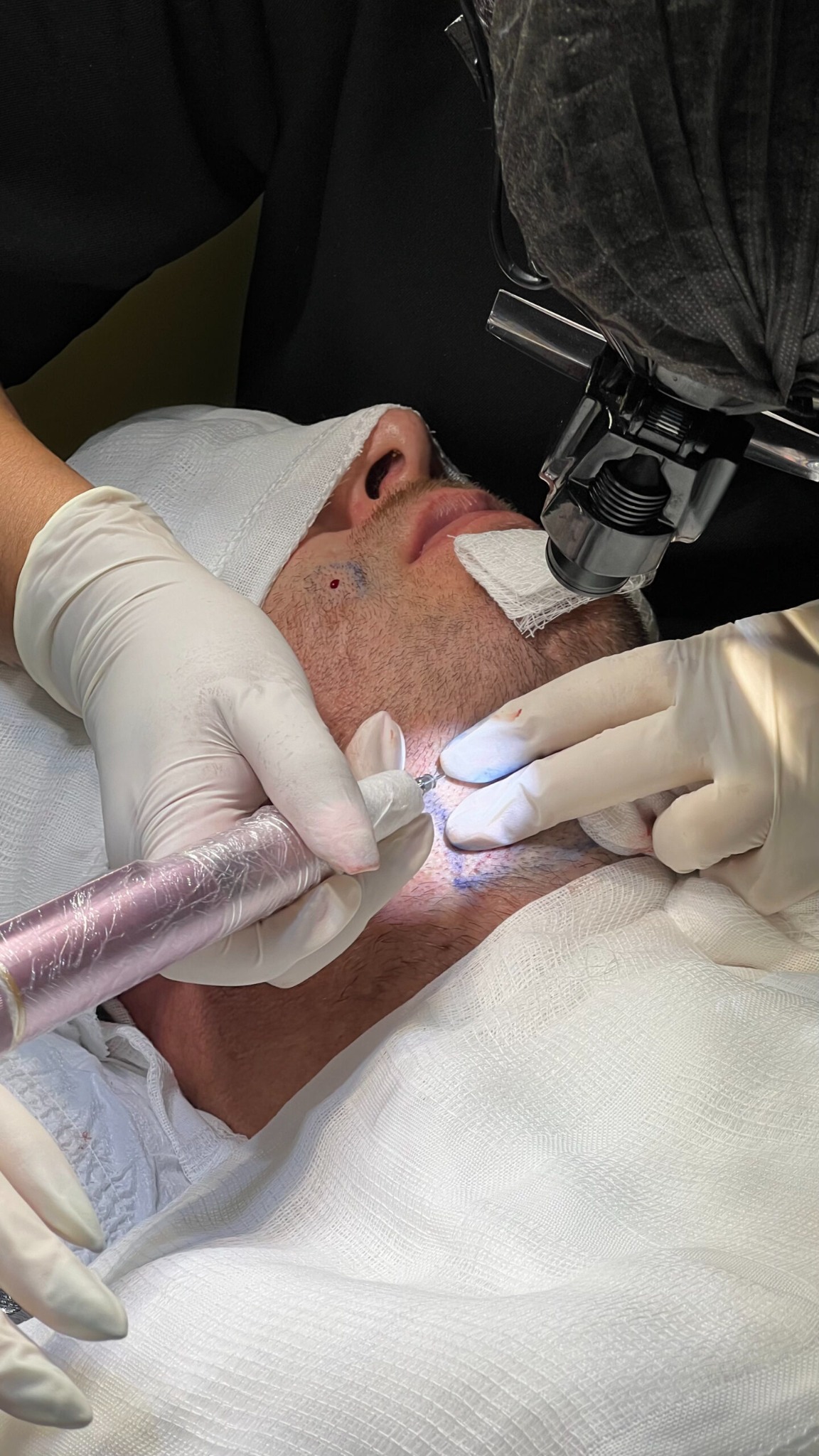 Procedimento de transplante capilar