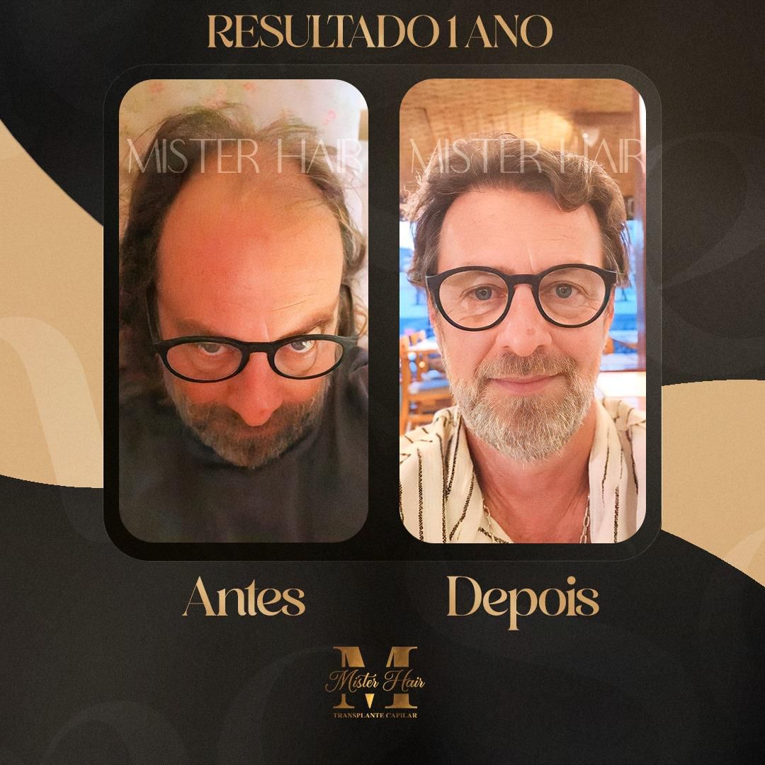 Antes e depois de transplante capilar, resultado após 1 ano
