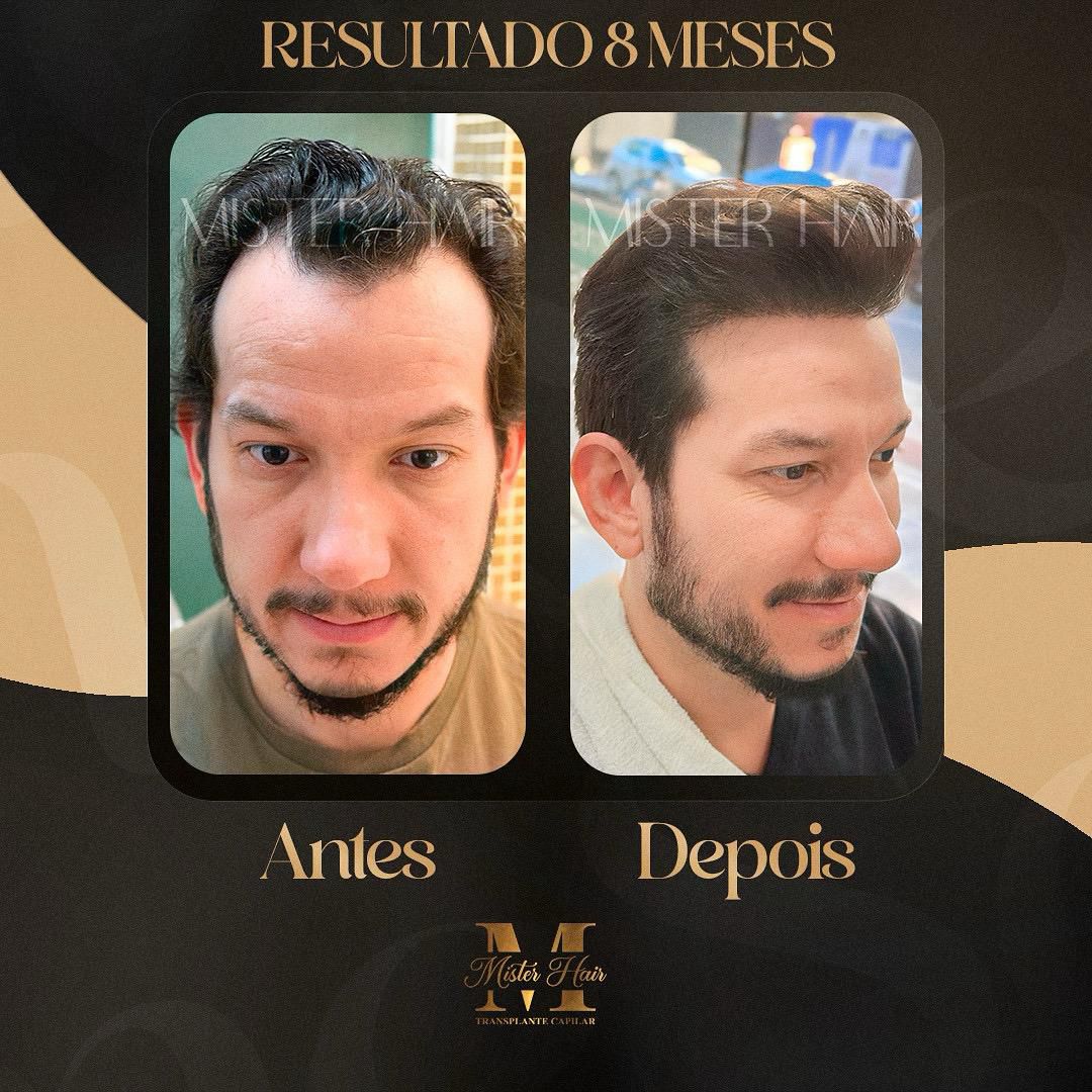 Antes e depois de transplante capilar, resultado após 8 meses